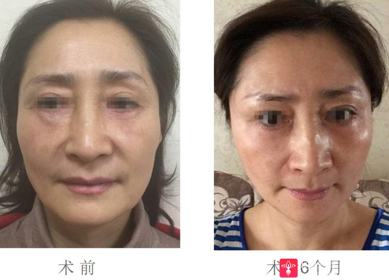 面部提升术