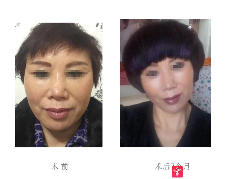 面部提升术