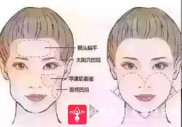 面部提升术
