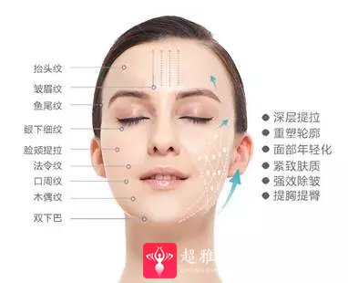 面部提升术