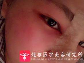 隆鼻手术