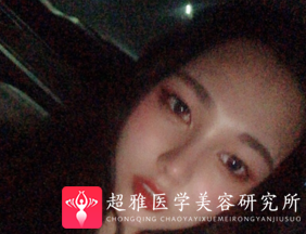 隆鼻手术