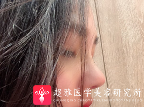 隆鼻手术