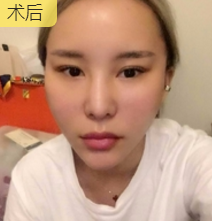 面部提升术
