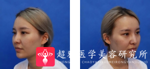 面部提升术