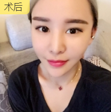 面部提升术