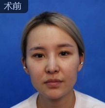 面部提升术