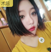 面部提升术
