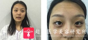 面部提升术