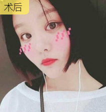 面部提升术