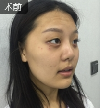 面部提升术