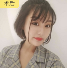 面部提升术