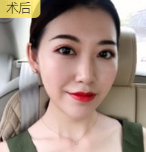 面部提升术
