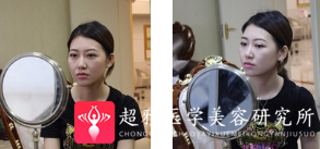 面部提升术