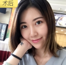 面部提升术