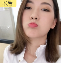 面部提升术