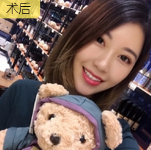 面部提升术