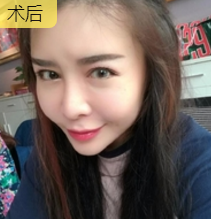 面部提升术