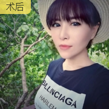 面部提升术