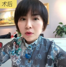 面部提升术
