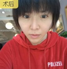 面部提升术