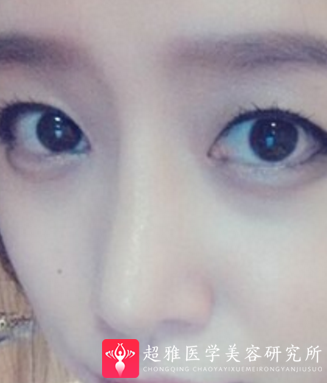 不开刀隆鼻