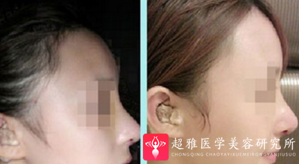 不开刀隆鼻