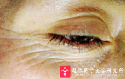 面部提升术
