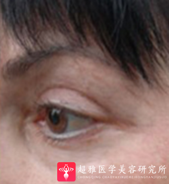 面部提升术