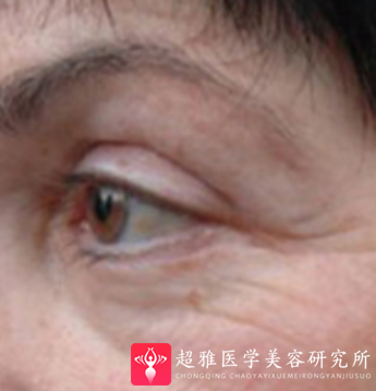 面部提升术