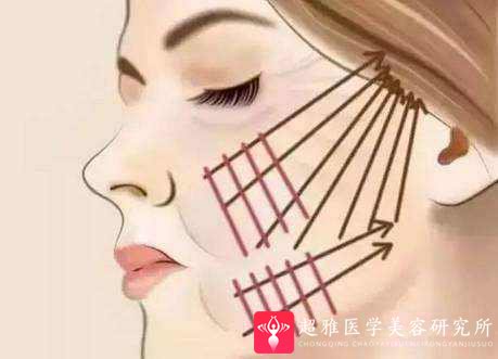 面部提升术
