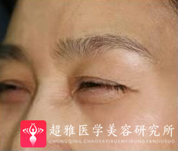 面部提升术