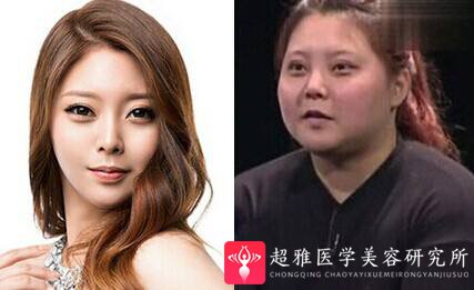 超声波瘦脸