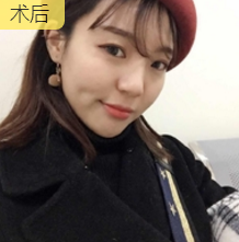 面部提升术