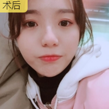 面部提升术