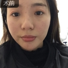 面部提升术