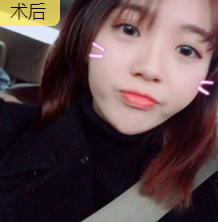 面部提升术