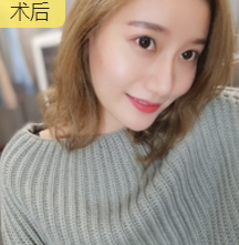 面部提升术