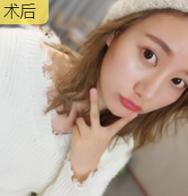 面部提升术