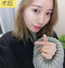 面部提升术