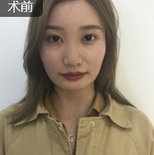 面部提升术