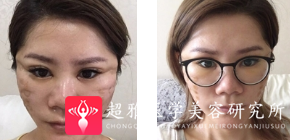 面部提升术
