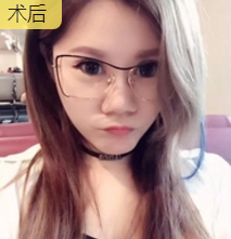 面部提升术