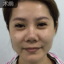 面部提升术