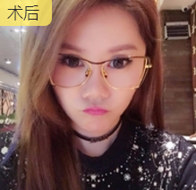 面部提升术