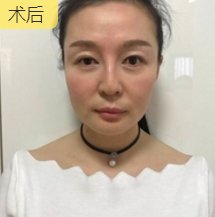 面部提升术