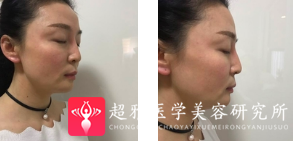 面部提升术