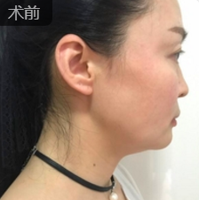 面部提升术