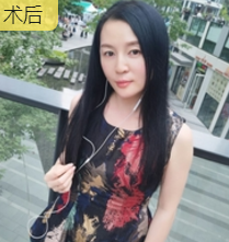 面部提升术