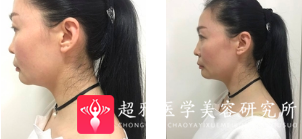 面部提升术